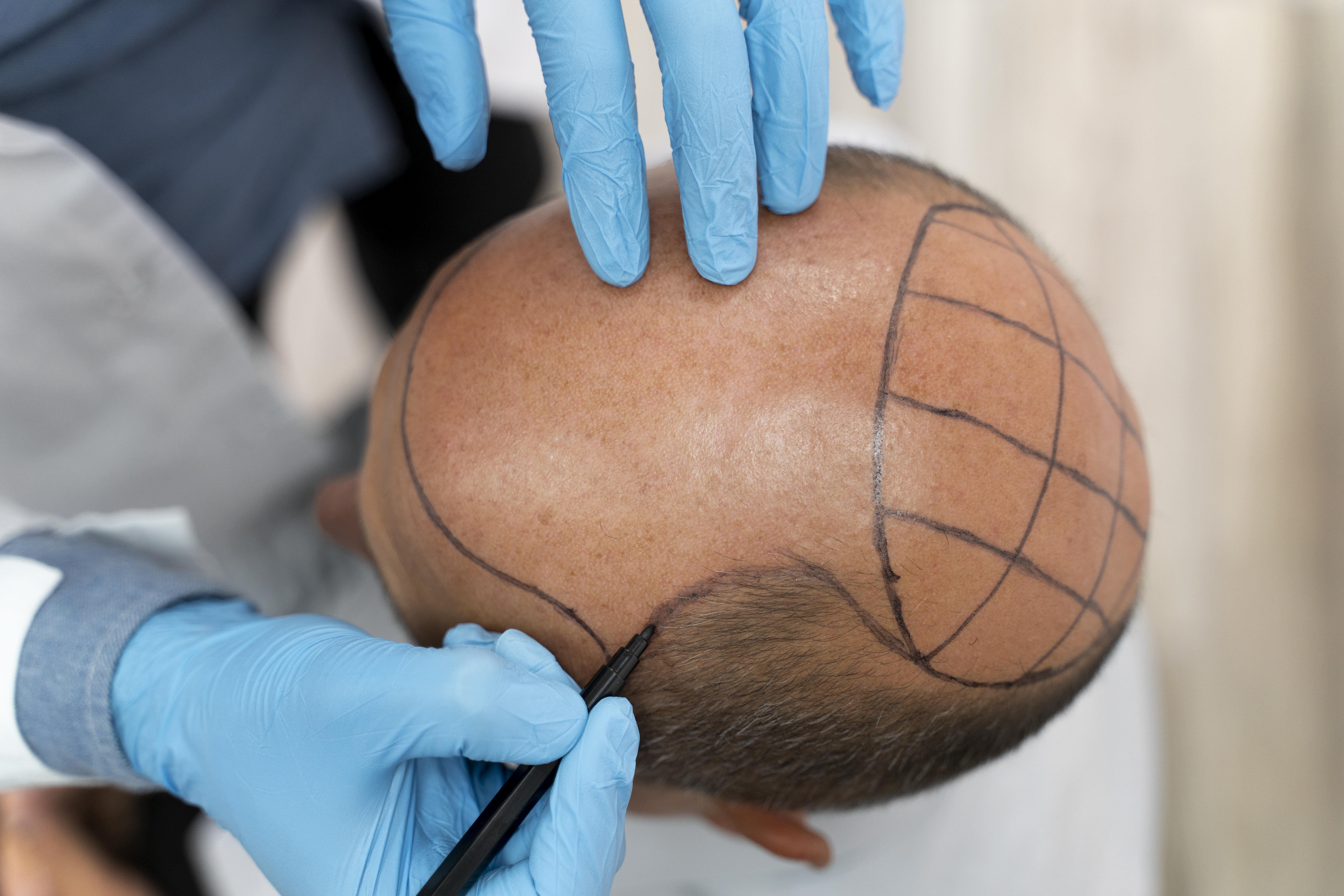 fut saç ekimi öncesi ve sonrası istanbul signature hair transplant