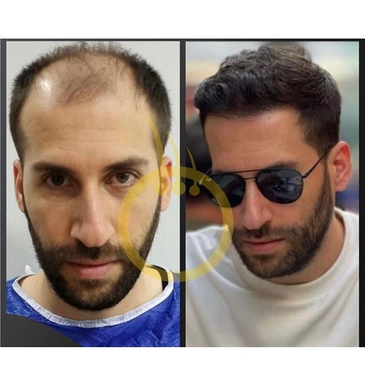 signature hair transplant saç ekim sonucu 1
