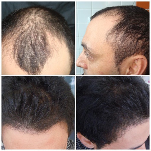 signature hair transplant saç ekim sonucu 2