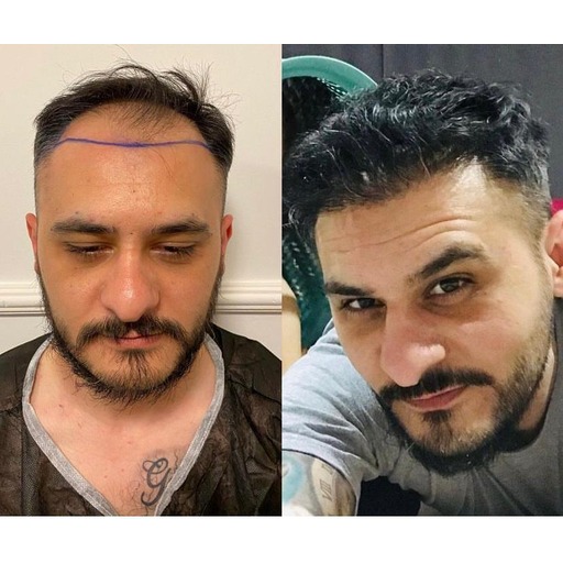 signature hair transplant saç ekim sonucu 3
