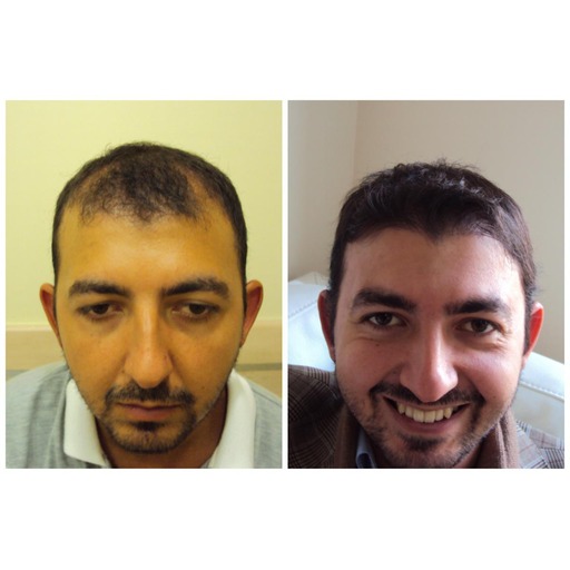 signature hair transplant saç ekim sonucu 4